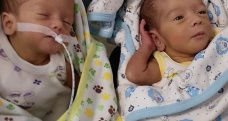 7 aylık doğan ikizler sağlığına kavuştu